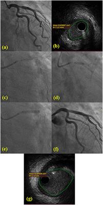 Feasibility and Safety of Drug-Coated Balloon-Only Angioplasty for De Novo Ostial Lesions of the Left Anterior Descending Artery: Two-Center Retrospective Study